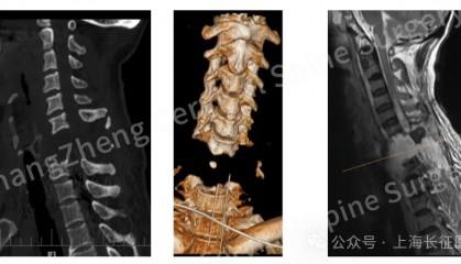 全球罕见！中国医生救回“身首离断”患者